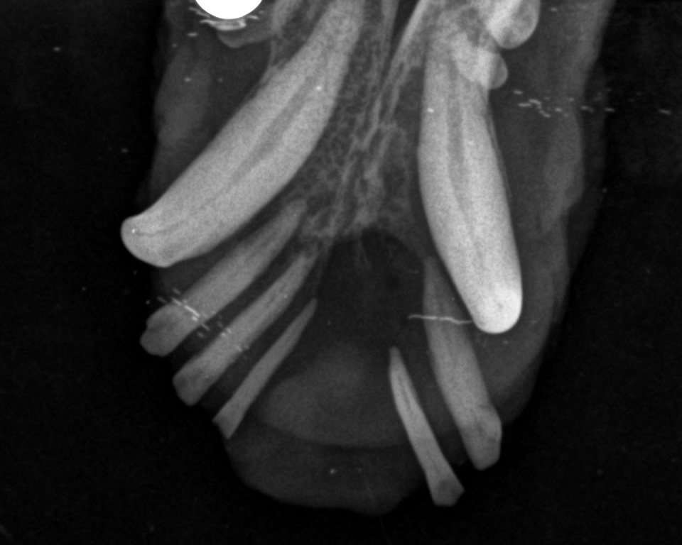 Radiographie tumeur buccale - 2
